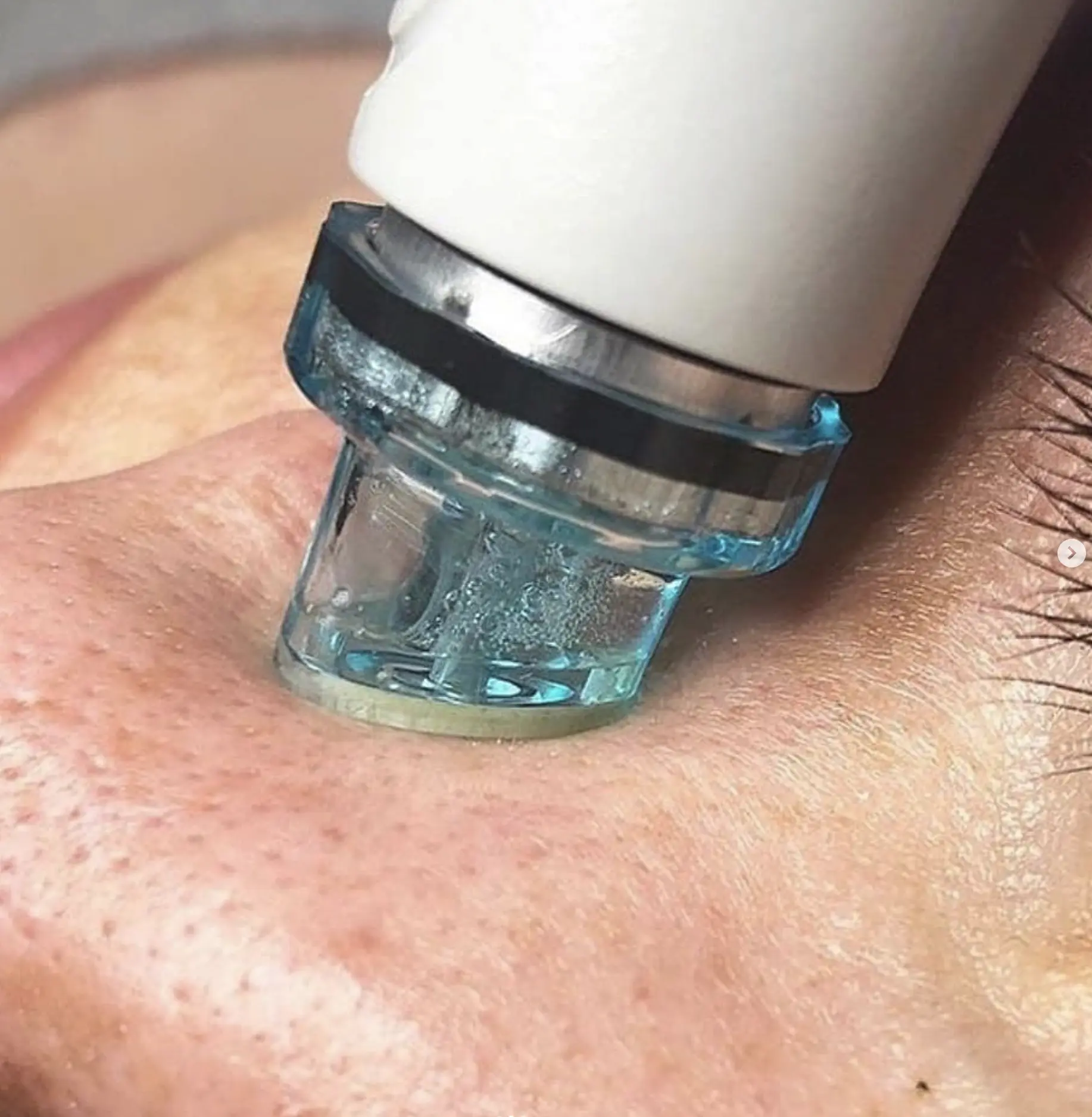 what does a hydrafacial do